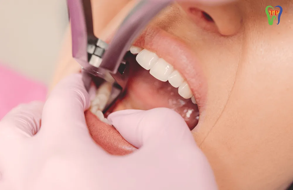 Khi nào cần nhổ răng vĩnh viễn? Những lưu ý khi nhổ răng vĩnh viễn bạn cần biết