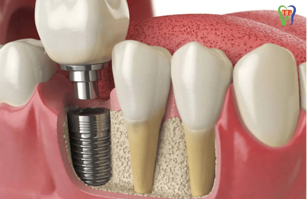 Cấy Implant uy tín tại Đà Nẵng – Lựa chọn hoàn hảo cho nụ cười hoàn hảo